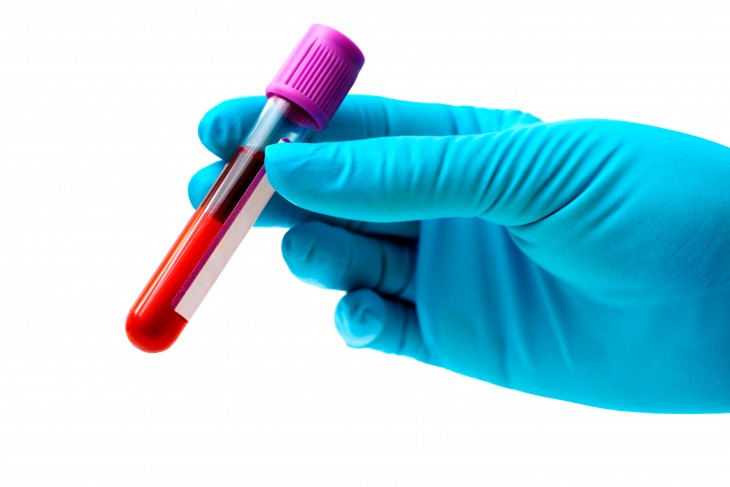 Artigo – Descoberta de exame de sangue para detectar câncer antes de diagnóstico padrão deve ser comemorada